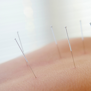 Dry needling Parramatta